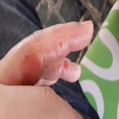 手廯怎么办