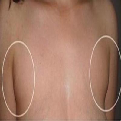 副乳怎么解决