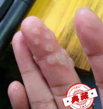赘疣（祛除猴子）的小偏方---鸦胆子